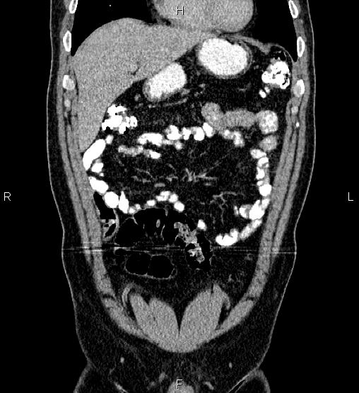 Acute appendicitis (Radiopaedia 84780-100240 Coronal C+ portal venous phase 19).jpg