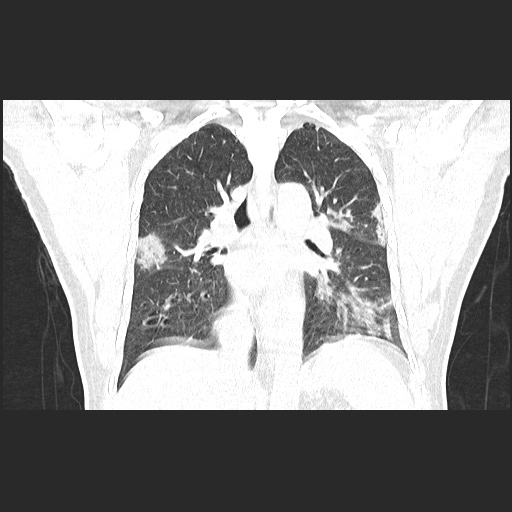 Acute appendicitis and COVID 19 pneumonia (Radiopaedia 76604-88380 G 38).jpg