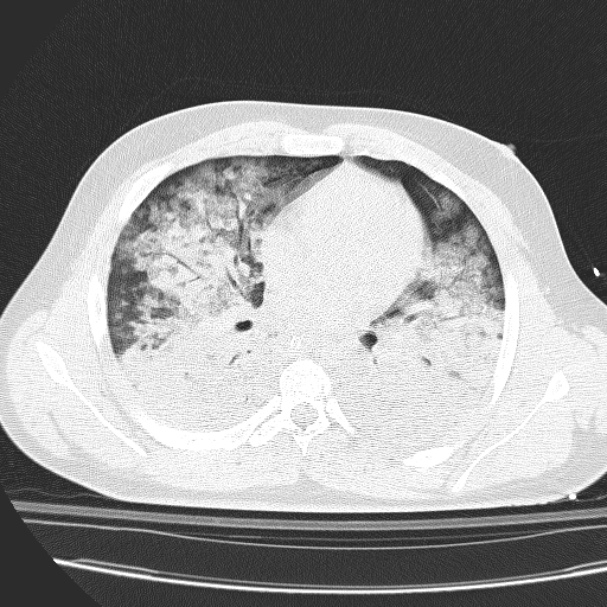 Acute aspiration pneumonitis (Radiopaedia 33605-34703 Axial lung window 52).jpg