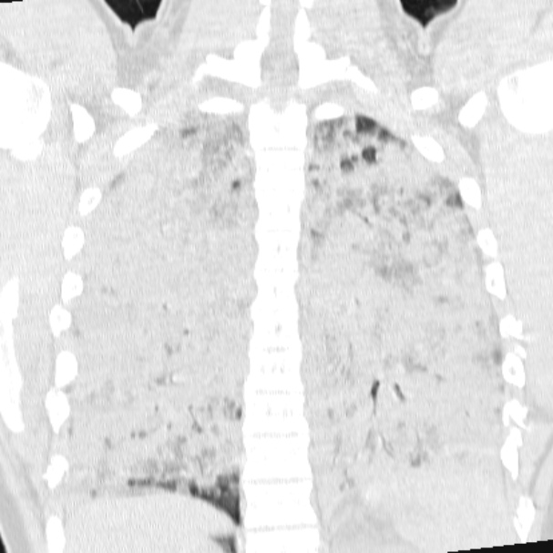 Acute aspiration pneumonitis (Radiopaedia 33605-34703 Coronal lung window 57).jpg