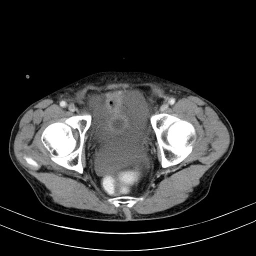 Acute bowel ischemia (Radiopaedia 87695-104114 Axial C+ portal venous phase 80).jpg