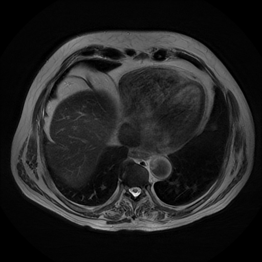 File:Acute cholecystitis complicated by pylephlebitis (Radiopaedia 65782-74915 Axial T2 4).jpg