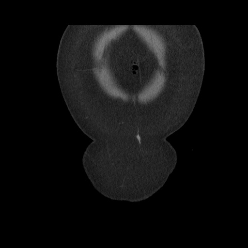 Acute cholecystitis with tensile fundus sign (Radiopaedia 71394-81723 Coronal non-contrast 19).jpg