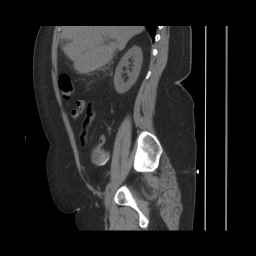 File:Acute cholecystitis with tensile fundus sign (Radiopaedia 71394-81723 Sagittal non-contrast 66).jpg