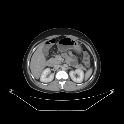 File:Acute complicated calculous cholecystitis (Radiopaedia 55202-61587 Axial C+ delayed 39).jpg