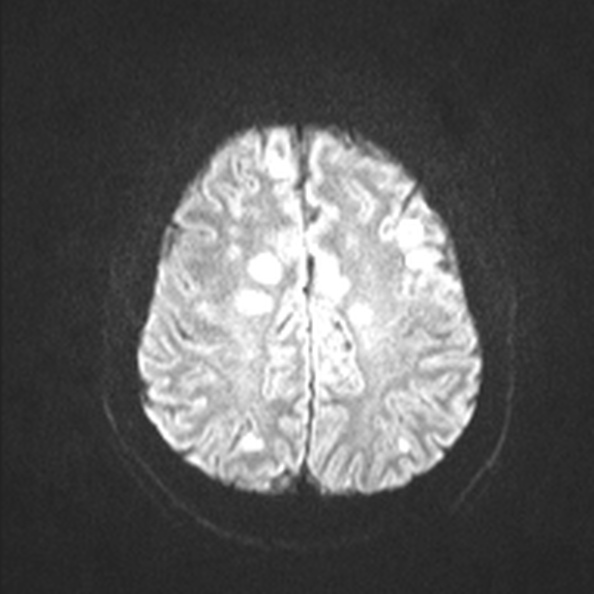 Acute disseminated encephalomyelitis (Radiopaedia 37253-39033 Axial DWI 47).jpg