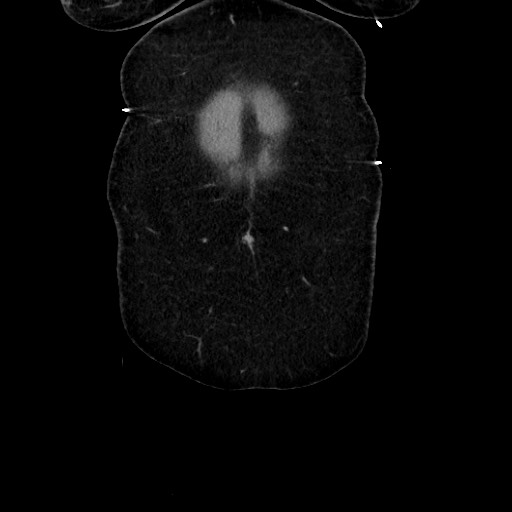 Acute diverticulitis - transverse colon (Radiopaedia 87063-103327 Coronal C+ portal venous phase 30).jpg
