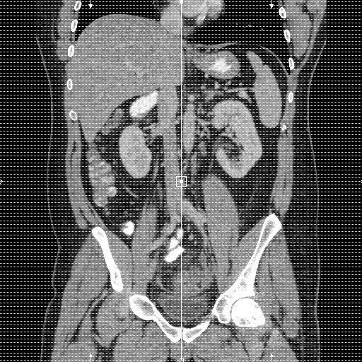 Acute diverticulitis with localized perforation (Radiopaedia 41296-44113 Axial C+ portal venous phase 1).jpg