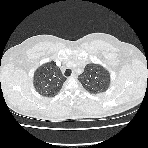 Acute epicardial fat necrosis (Radiopaedia 42327-45440 Axial lung window 16).jpg