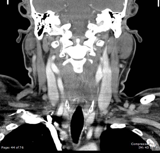 Acute epiglottitis (Radiopaedia 54375-60590 Coronal C+ arterial phase 44).jpg