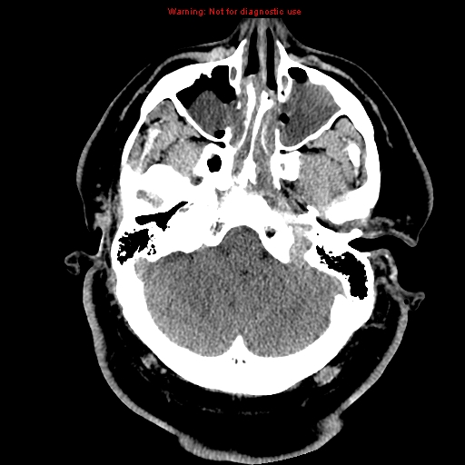 Acute hemorrhagic leukoencephalitis (Radiopaedia 14076-13920 Axial non-contrast 7).jpg