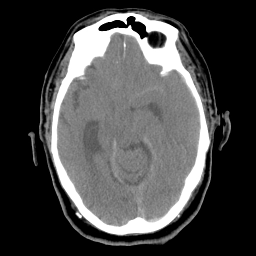 Acute hemorrhagic stroke (Radiopaedia 17507-17223 Axial non-contrast 21).jpg