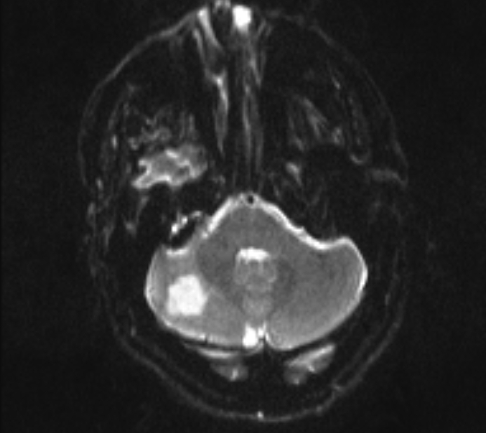 Acute ischemic stroke - posterior circulation territory (Radiopaedia 77670-89880 Axial DWI 6).jpg