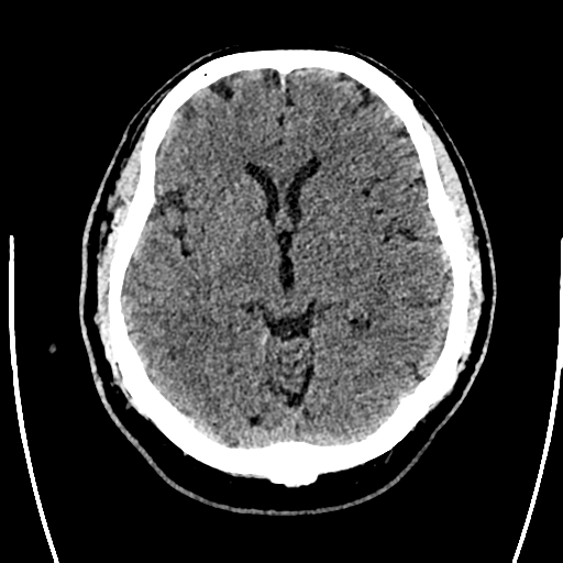 Acute left middle cerebral artery territory ischemic stroke (Radiopaedia 35688-37223 Axial non-contrast 36).png