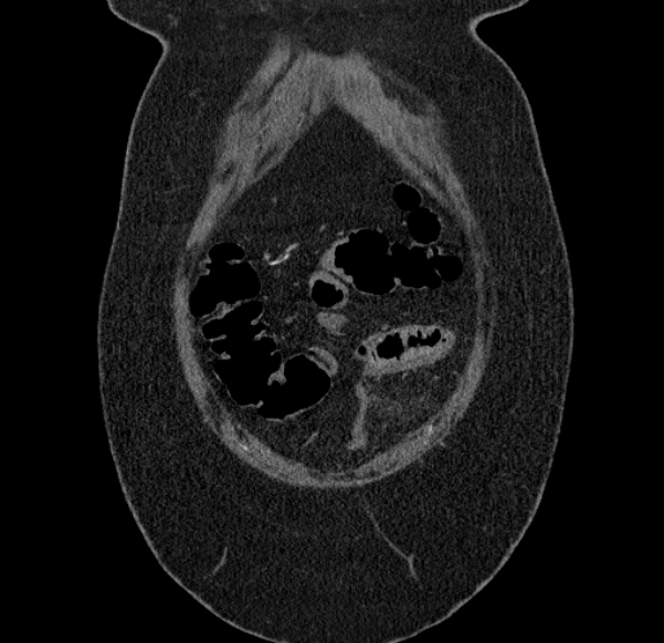 Acute mesenteric ischemia (Radiopaedia 80029-93316 Coronal C+ arterial phase 9).jpg