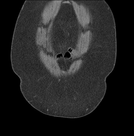 Acute mesenteric venous ischemia (Radiopaedia 46041-50383 Coronal C+ portal venous phase 10).jpg