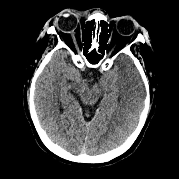 Acute middle cerebral artery territory infarct (Radiopaedia 52380-58283 Axial non-contrast 40).jpg