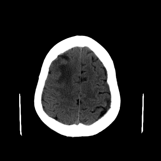 File:Acute necrotizing toxoplasma encephalitis (Radiopaedia 10683-11150 B 8).jpg