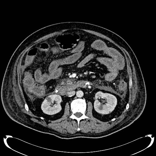 Acute pancreatic necrosis (Radiopaedia 13560-18500 Axial C+ portal venous phase 75).jpg