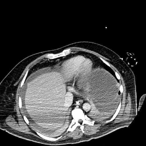 Acute pancreatic necrosis (Radiopaedia 13560-18501 Axial C+ portal venous phase 5).jpg