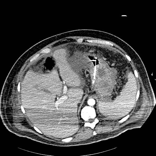 Acute pancreatic necrosis (Radiopaedia 13560-18502 Axial C+ portal venous phase 6).jpg