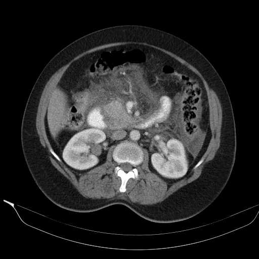 File:Acute pancreatitis (Radiopaedia 20829-20744 Axial C+ portal venous phase 21).jpg