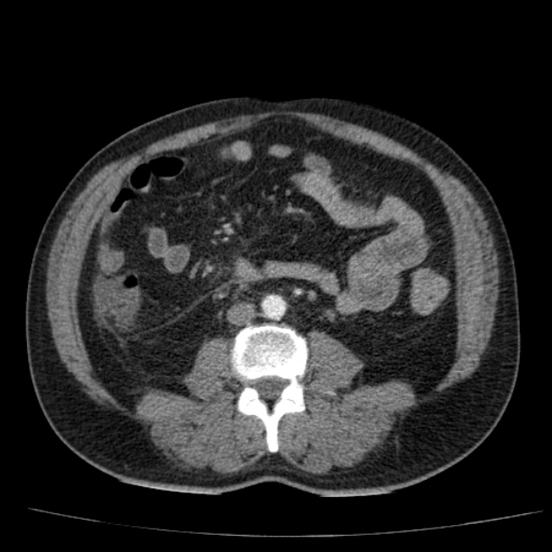 Acute pancreatitis (Radiopaedia 26663-26813 Axial C+ arterial phase 59).jpg