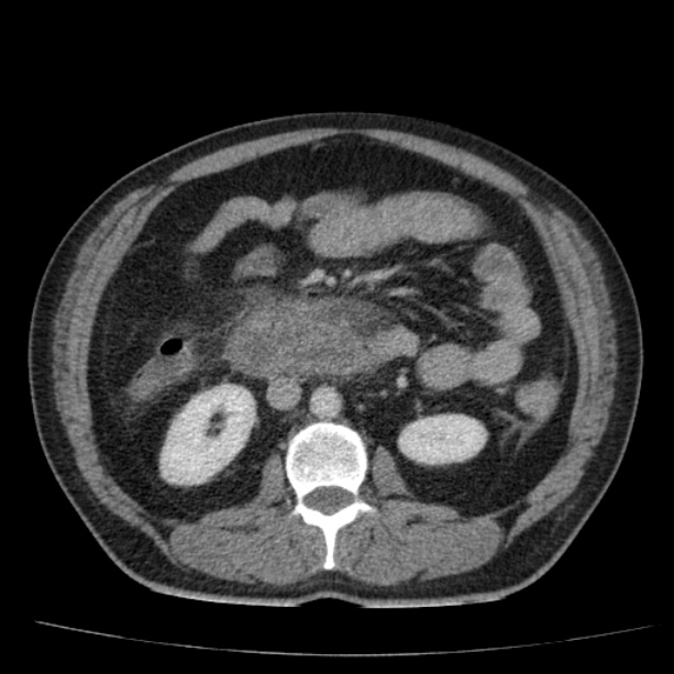 Acute pancreatitis (Radiopaedia 26663-26813 Axial C+ portal venous phase 41).jpg