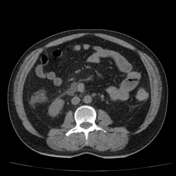 Acute pancreatitis (Radiopaedia 26663-26813 Axial non-contrast 55).jpg