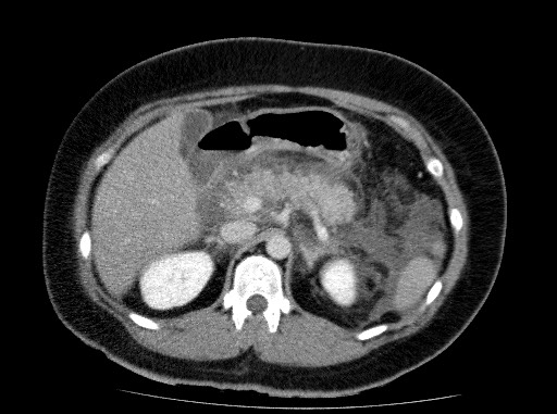 Acute pancreatitis (Radiopaedia 69236-79012 Axial C+ portal venous phase 31).jpg