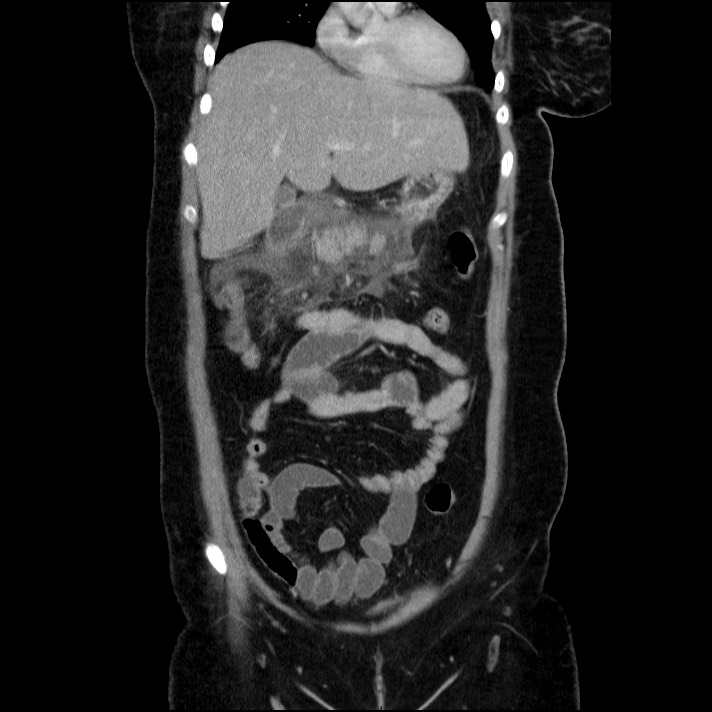 Acute pancreatitis (Radiopaedia 69236-79012 Coronal C+ portal venous phase 51).jpg