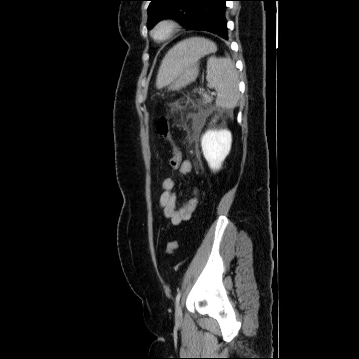 Acute pancreatitis (Radiopaedia 69236-79012 Sagittal C+ portal venous phase 31).jpg