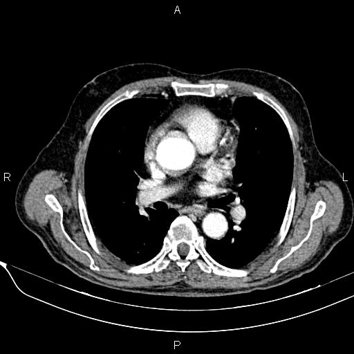 File:Acute pancreatitis (Radiopaedia 85146-100701 Axial C+ arterial phase 9).jpg