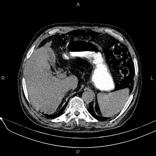 Acute pancreatitis (Radiopaedia 85146-100701 Axial non-contrast 31).jpg