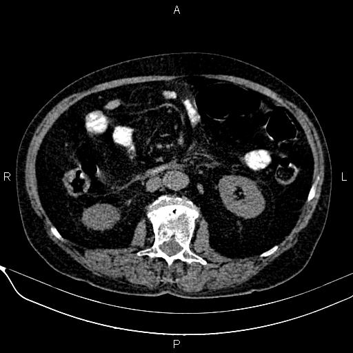 File:Acute pancreatitis (Radiopaedia 85146-100701 Axial non-contrast 61).jpg