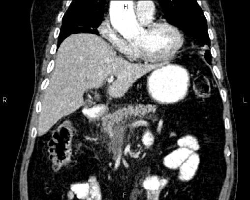 Acute pancreatitis (Radiopaedia 85146-100701 Coronal C+ portal venous phase 28).jpg