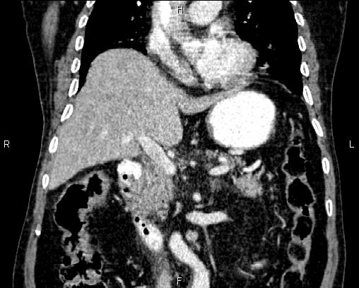 Acute pancreatitis (Radiopaedia 85146-100701 Coronal C+ portal venous phase 36).jpg