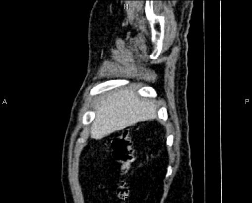 Acute pancreatitis (Radiopaedia 85146-100701 Sagittal C+ portal venous phase 5).jpg