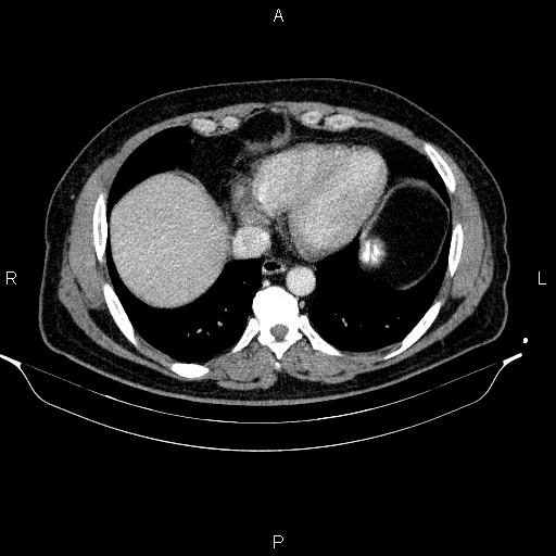 File:Acute pancreatitis (Radiopaedia 85390-101010 Axial C+ portal venous phase 9).jpg