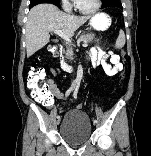 Acute pancreatitis (Radiopaedia 85390-101010 Coronal C+ portal venous phase 33).jpg