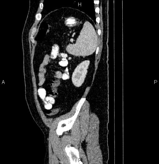 Acute pancreatitis (Radiopaedia 85390-101010 Sagittal C+ portal venous phase 87).jpg
