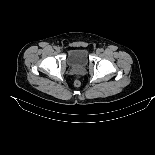 File:Acute pancreatitis (Radiopaedia 87428-103757 Axial non-contrast 92).jpg