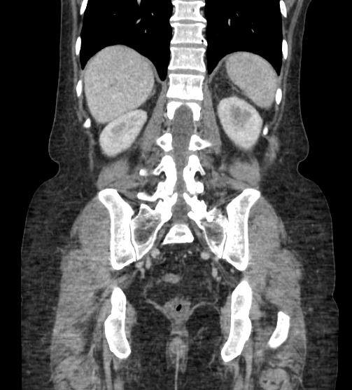 Acute pancreatitis - Balthazar E - post ERCP (Radiopaedia 27562-27772 Coronal C+ portal venous phase 66).png