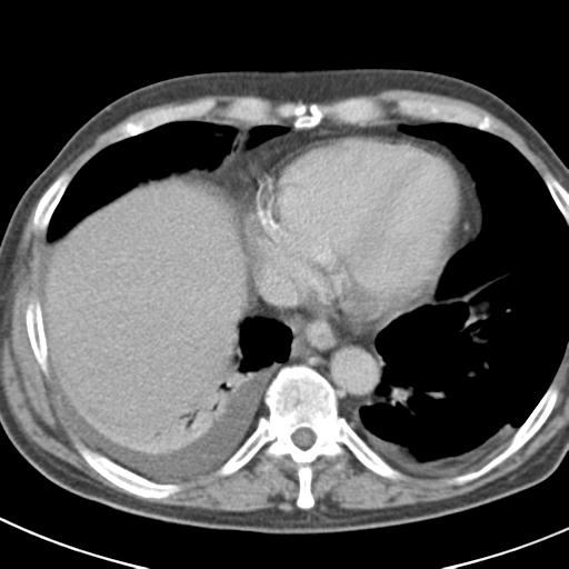 Acute pancreatitis and walled-off necrosis (Radiopaedia 29888-30403 Axial C+ delayed 10).jpg
