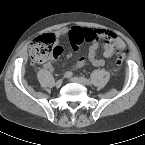 File:Acute pancreatitis and walled-off necrosis (Radiopaedia 29888-30403 Axial non-contrast 54).jpg