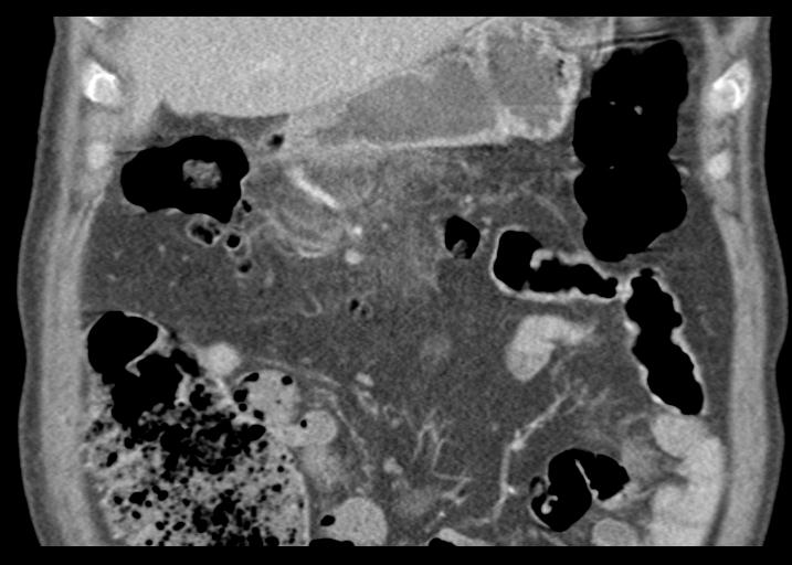 Acute pancreatitis and walled-off necrosis (Radiopaedia 29888-30403 Coronal C+ portal venous phase 18).jpg