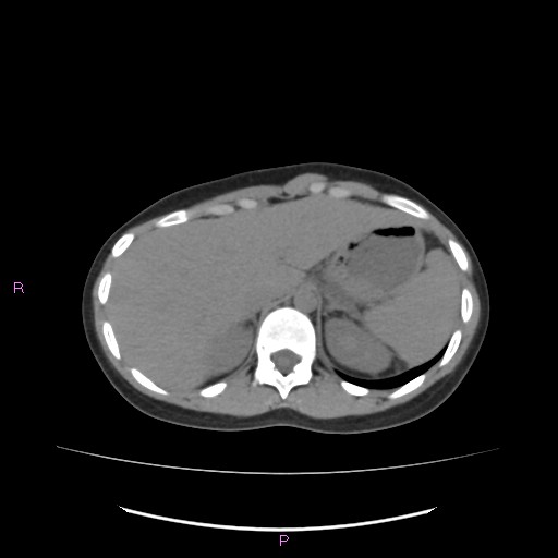 Acute pancreatitis secondary to stone at minor papilla and pancreatic divisum (Radiopaedia 76570-88333 Axial non-contrast 15).jpg