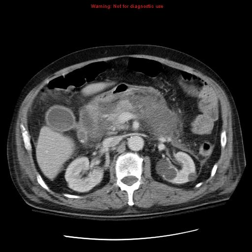 File:Acute pancreatitis with incidental pancreatic lipoma (Radiopaedia 10190-10730 Axial C+ portal venous phase 27).jpg