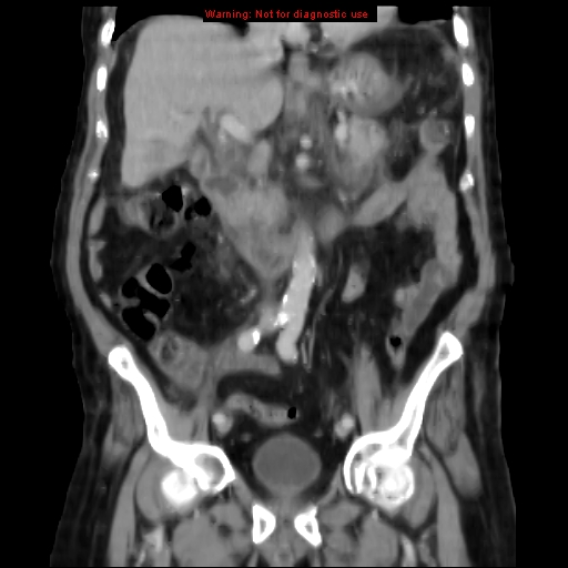 Acute pancreatitis with incidental pancreatic lipoma (Radiopaedia 10190-10730 Coronal C+ portal venous phase 34).jpg