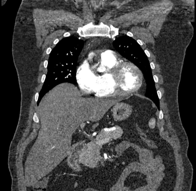 Acute pulmonary embolism with pulmonary infarcts (Radiopaedia 77688-89908 Coronal C+ CTPA 19).jpg